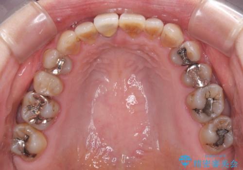 咬み合わせを治したい インビザラインによる矯正治療の治療中