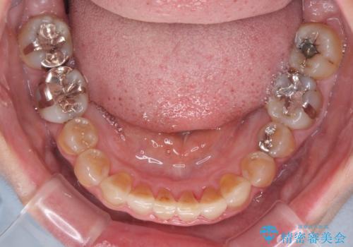 咬み合わせを治したい インビザラインによる矯正治療の治療中