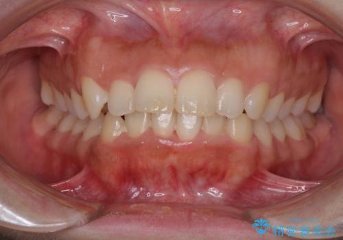 口がしっかりと閉じられない　ワイヤー装置での抜歯矯正で出っ歯を改善の症例 治療前