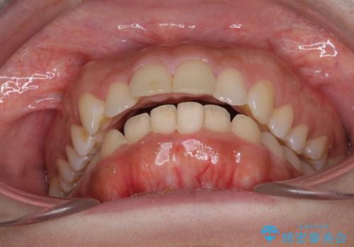 口がしっかりと閉じられない ワイヤー装置での抜歯矯正で出っ歯を改善の治療前