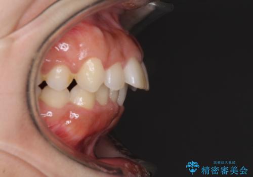 口がしっかりと閉じられない ワイヤー装置での抜歯矯正で出っ歯を改善の治療前