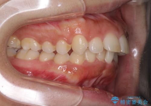 口がしっかりと閉じられない　ワイヤー装置での抜歯矯正で出っ歯を改善の治療前