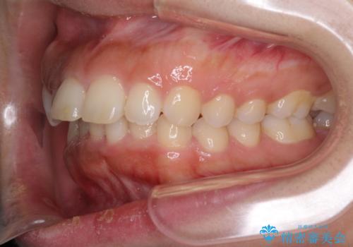 口がしっかりと閉じられない ワイヤー装置での抜歯矯正で出っ歯を改善の治療前