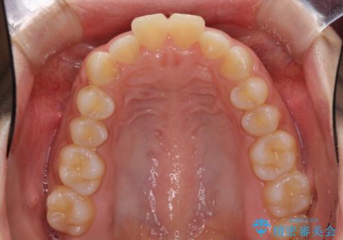 口がしっかりと閉じられない ワイヤー装置での抜歯矯正で出っ歯を改善の治療前