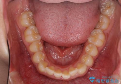 口がしっかりと閉じられない　ワイヤー装置での抜歯矯正で出っ歯を改善の治療前