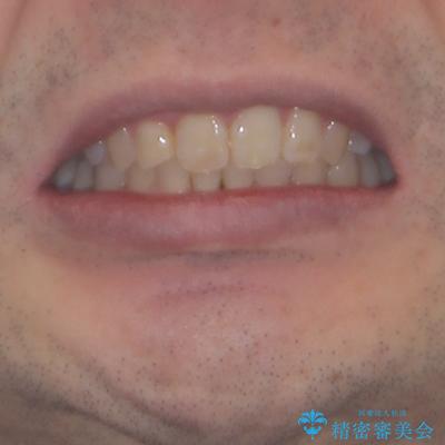 前歯が折れたついでに歯並びも改善　矯正治療と前歯のセラミック治療の治療後（顔貌）