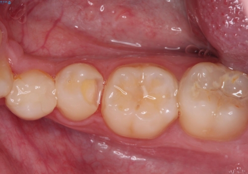 詰め物が欠けた セラミックインレーによる修復の治療中