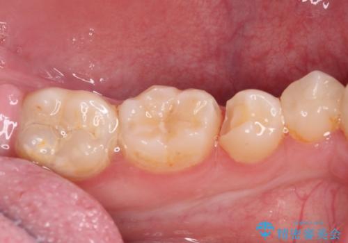 詰め物が欠けた セラミックインレーによる修復の治療中