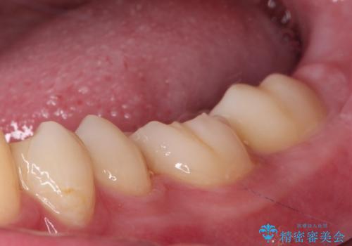 詰め物が欠けた セラミックインレーによる修復の治療中