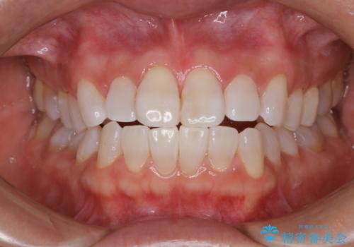 オフィスホワイトニングの症例 治療後