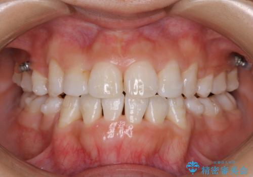 インビザライン中のクリーニング(PMTC)の症例 治療後