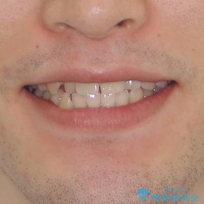 八重歯と前歯のクロスバイト　ワイヤー装置で短期間矯正の治療前（顔貌）