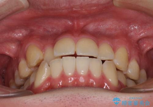 八重歯と前歯のクロスバイト　ワイヤー装置で短期間矯正の治療前
