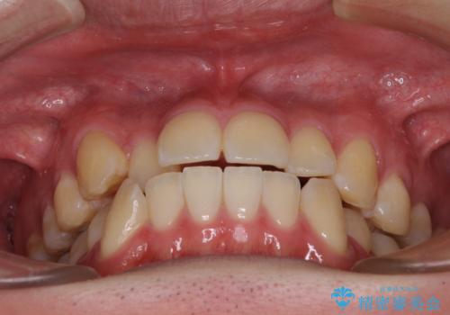 八重歯と前歯のクロスバイト ワイヤー装置で短期間矯正の治療前