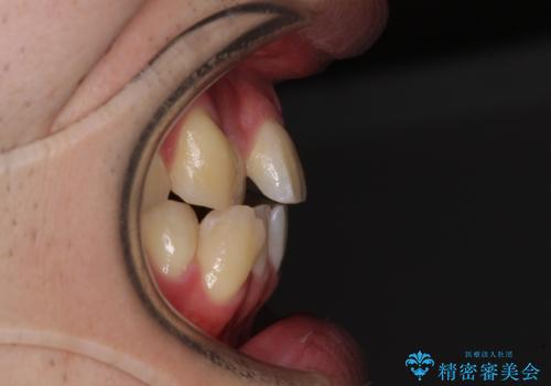 八重歯と前歯のクロスバイト　ワイヤー装置で短期間矯正の治療前