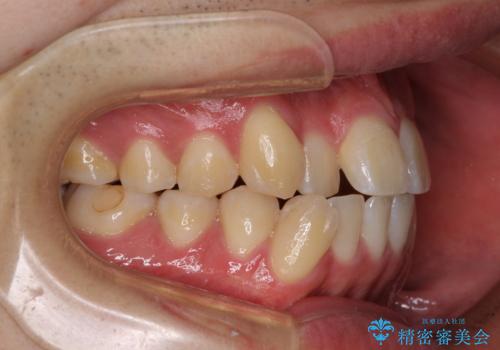 八重歯と前歯のクロスバイト ワイヤー装置で短期間矯正の治療前