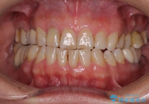 憧れの白い歯に　全顎セラミック治療の症例 治療前