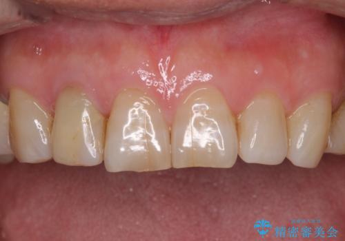 憧れの白い歯に　全顎セラミック治療の治療前