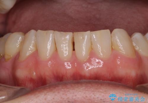 憧れの白い歯に　全顎セラミック治療の治療前