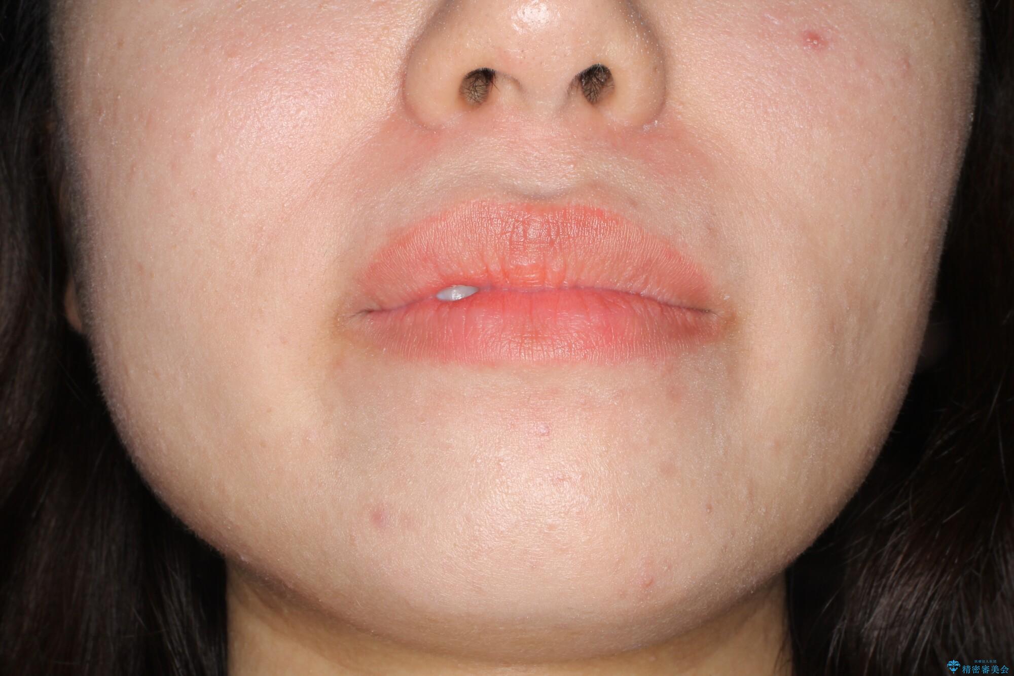 コンプレックスだった・・・唇が閉じなかった口元。綺麗になりました。の治療前(顔貌)