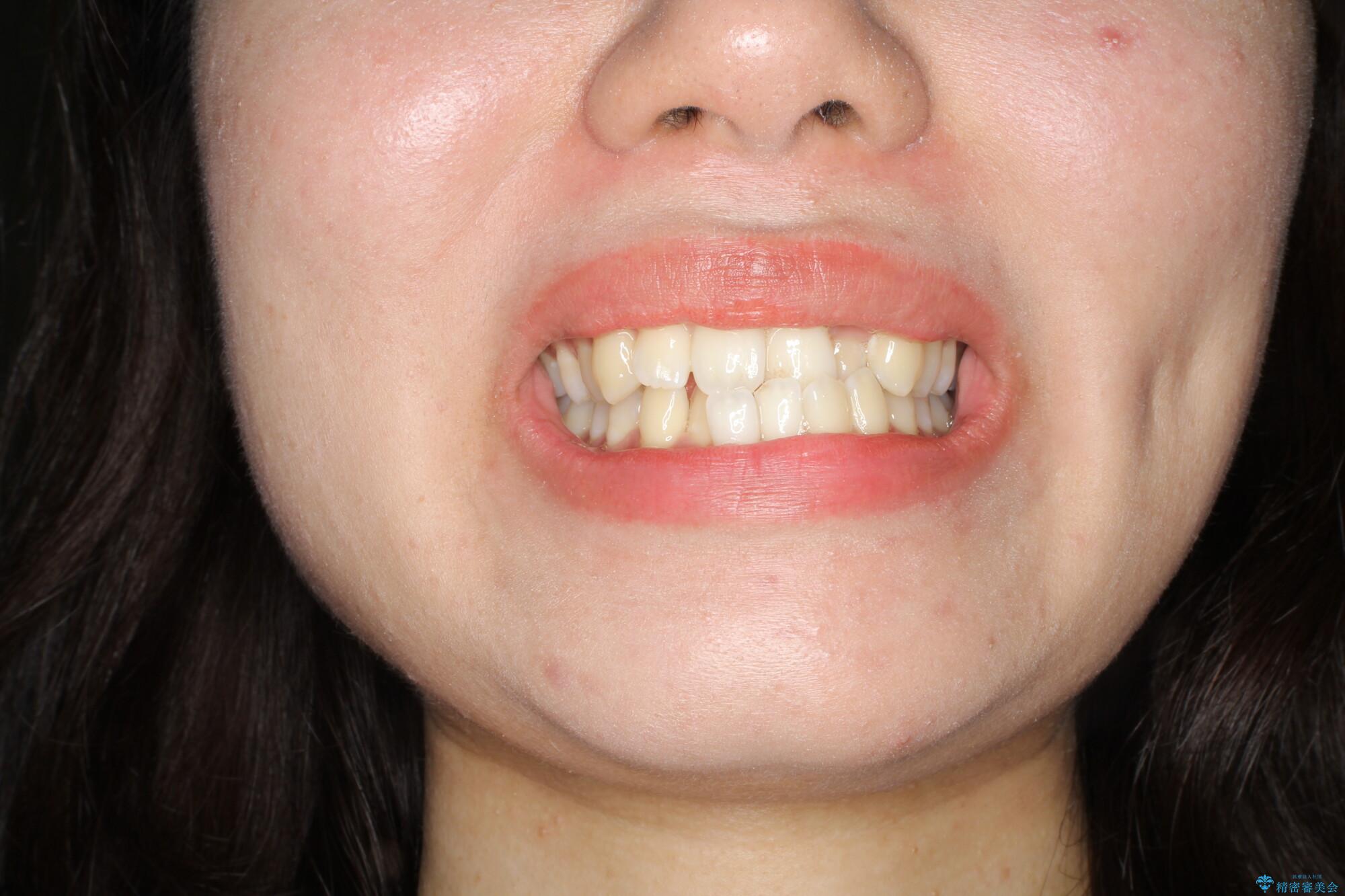 コンプレックスだった・・・唇が閉じなかった口元。綺麗になりました。の治療前(顔貌)