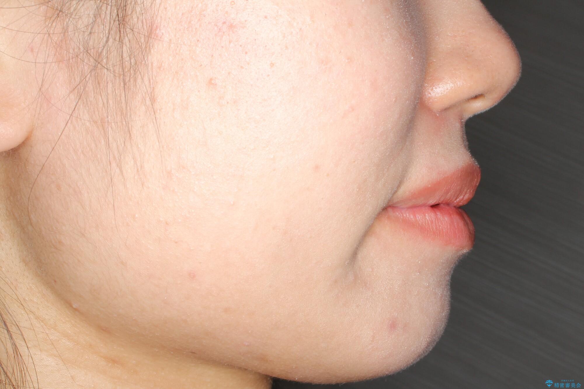 コンプレックスだった・・・唇が閉じなかった口元。綺麗になりました。の治療前(顔貌)