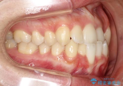 コンプレックスだった・・・唇が閉じなかった口元。綺麗になりました。の治療前