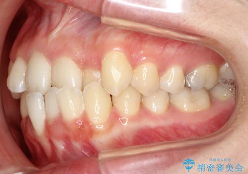 コンプレックスだった・・・唇が閉じなかった口元。綺麗になりました。の治療前