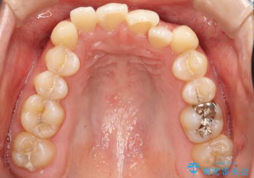 コンプレックスだった・・・唇が閉じなかった口元。綺麗になりました。の治療前