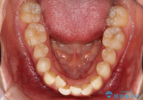 コンプレックスだった・・・唇が閉じなかった口元。綺麗になりました。の治療前
