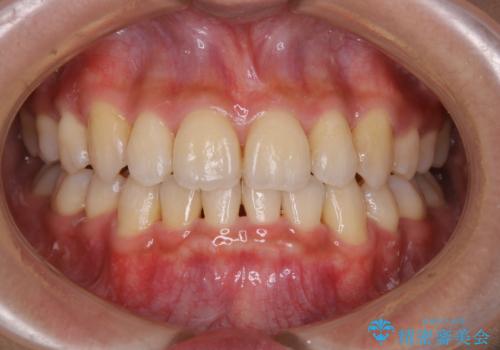 軽度な着色落としは、30分コースのPMTCの症例 治療前