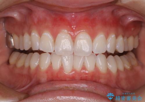 ホワイトニング(デュアルホワイトニング)の症例 治療後