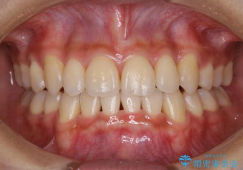 軽度な着色落としは、30分コースのPMTCの症例 治療後