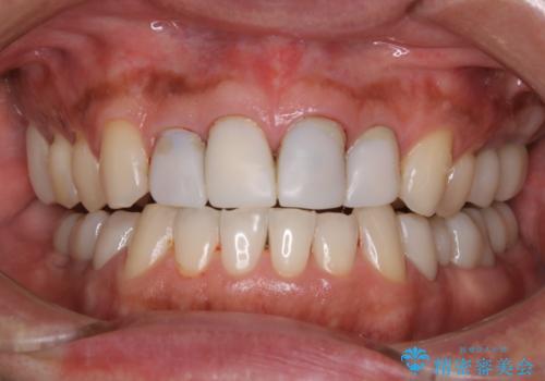 前歯のセラミックの被せ物に合わせてホワイトニングの治療前