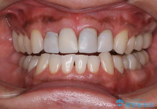 前歯のセラミックの被せ物に合わせてホワイトニングの症例 治療後