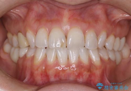 被せ物で見た目が変わる　前歯のセラミッククラウンの症例 治療前