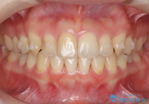 犬歯のねじれ 上の歯が引っ込んでいるの治療中