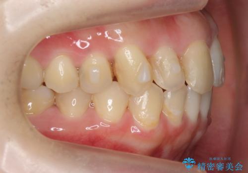 犬歯のねじれ 上の歯が引っ込んでいるの治療中