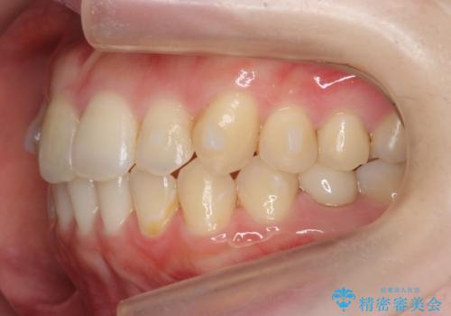 犬歯のねじれ 上の歯が引っ込んでいるの治療中