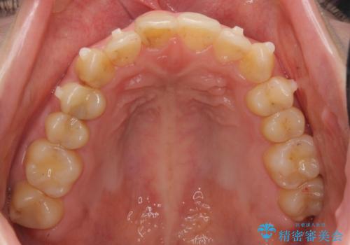 犬歯のねじれ 上の歯が引っ込んでいるの治療中