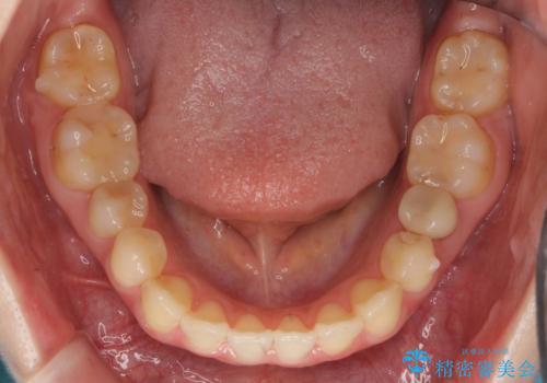 犬歯のねじれ 上の歯が引っ込んでいるの治療中