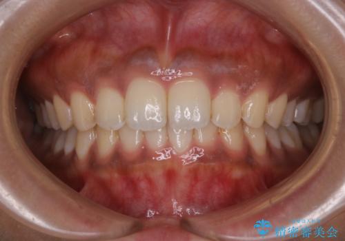 タバコのステインを徹底的に除去の治療前