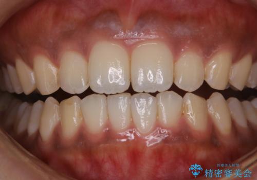 タバコのステインを徹底的に除去の治療前