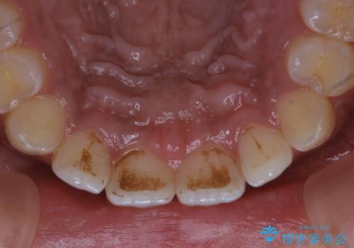 タバコのステインを徹底的に除去の治療前