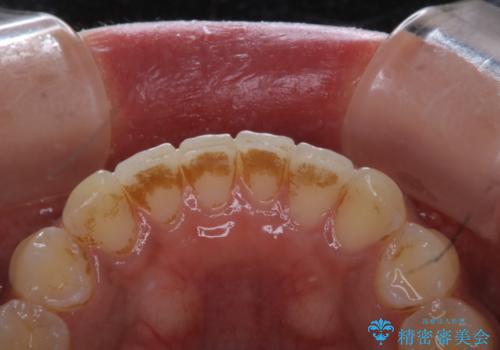 タバコのステインを徹底的に除去