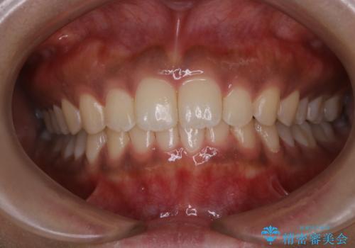 タバコのステインを徹底的に除去の治療後