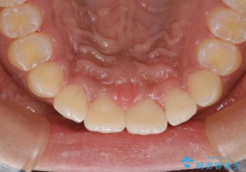 タバコのステインを徹底的に除去の治療後