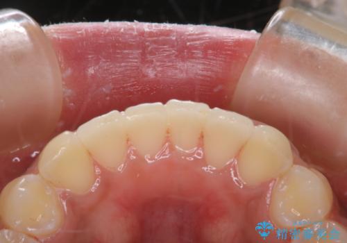 タバコのステインを徹底的に除去の治療後