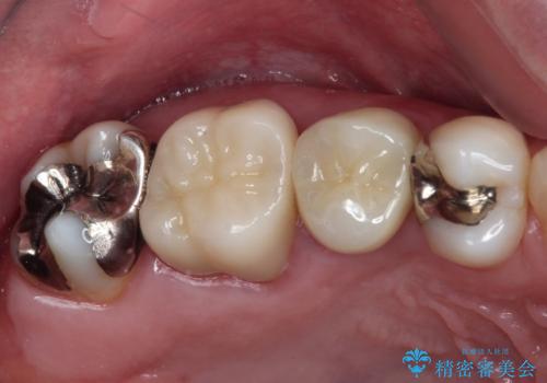 奥歯が痛い　セラミッククラウンでの虫歯治療の症例 治療後