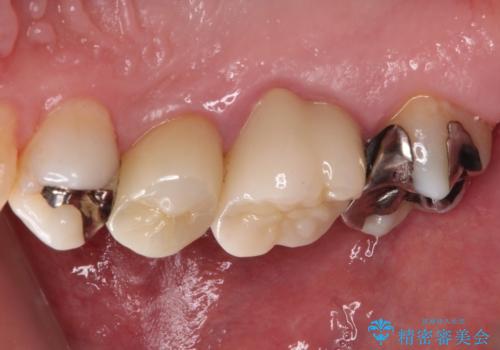 奥歯が痛い セラミッククラウンでの虫歯治療の治療後